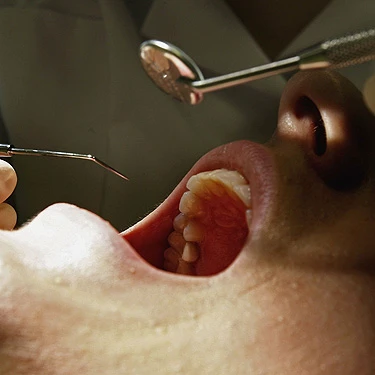 SUA: 600.000 $ despăgubiri pentru un „accident” la dentist!
