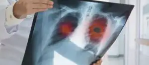 Terifiant! Cum arată plămânii unui pacient de coronavirus! Radiografie făcută după 3 zile de boală. COVID 19 acționează rapid FOTO