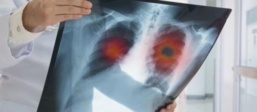 Terifiant! Cum arată plămânii unui pacient de coronavirus! Radiografie făcută după 3 zile de boală. COVID 19 acționează rapid FOTO