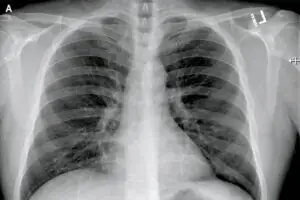 Un medic șochează! Ce pățesc plămânii afectați de coronavirus. Evoluția nu poate fi controlată