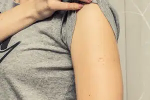 Marea Britanie a început vaccinarea antivariolică. Oferă protecție împotriva variolei maimuței