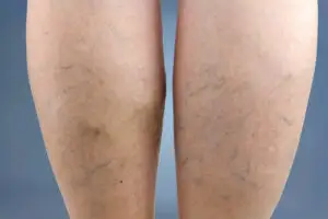 Venele tip pânză de păianjen. De ce apar și cum putem scăpa de ele