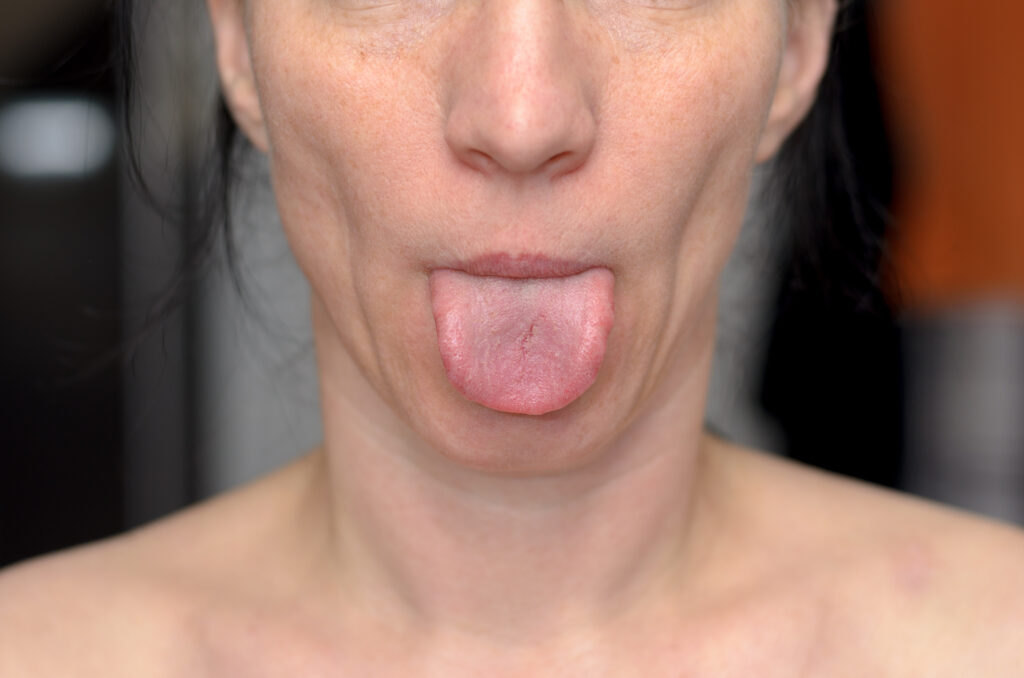 Simptomele limbii cu aspect de căpșuni. Ce boli ascunde