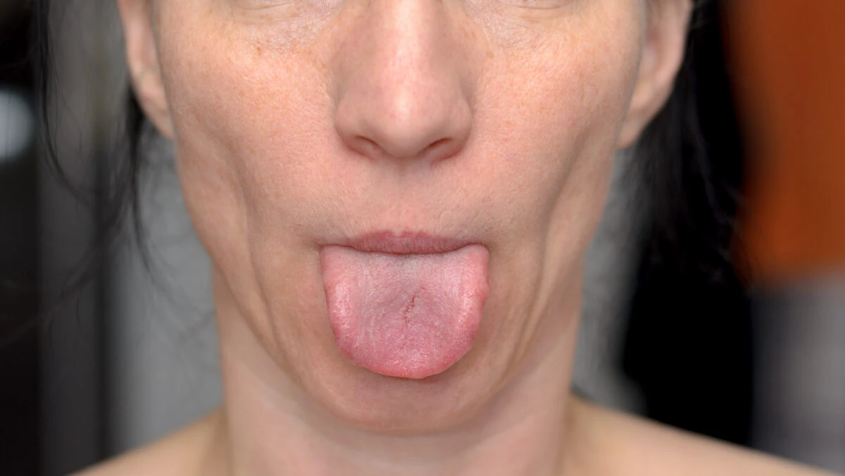 Ai „limba ondulată”? Bolile grave care se pot ascunde în spate