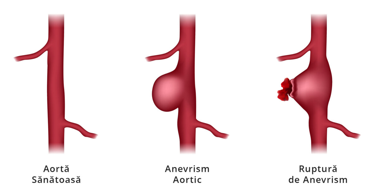 Anevrism Aortic