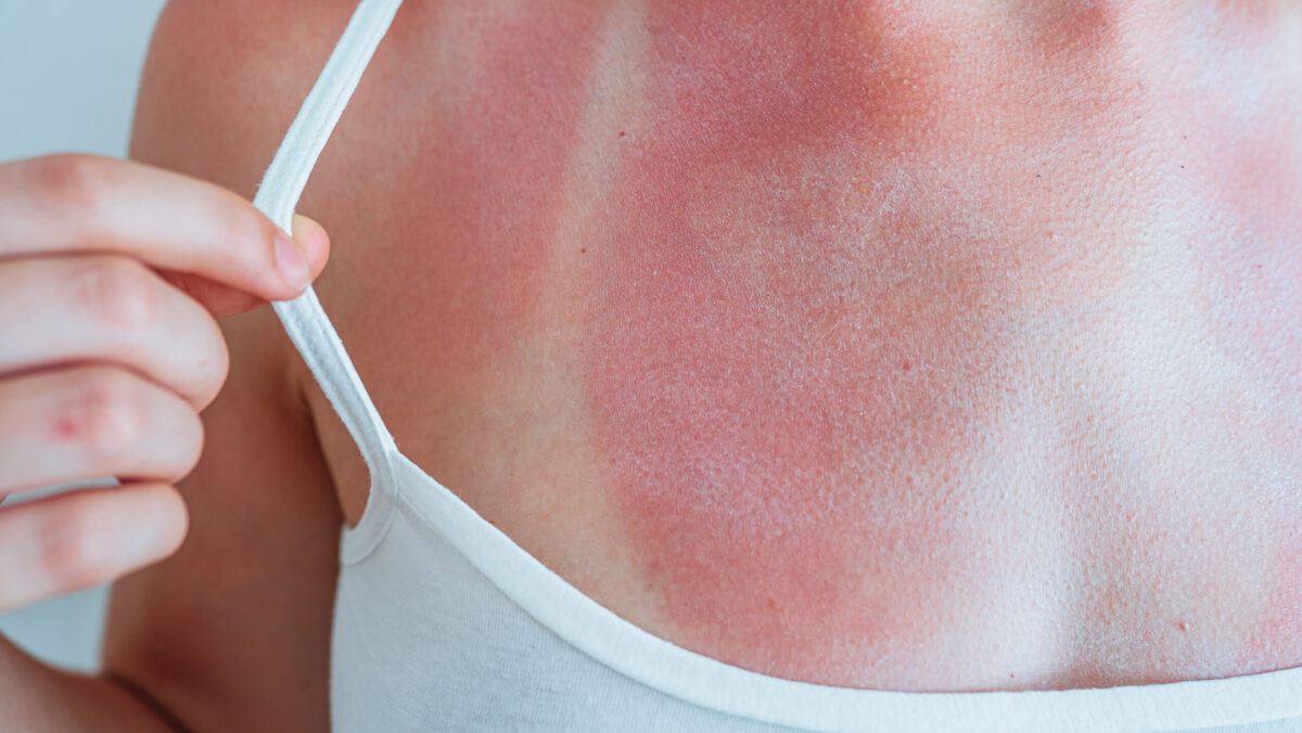 Poți inversa daunele provocate de soare pielii? Ce trebuie să faci când vii ars de la plajă