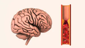 Ce legătură există între grupa sanguină și riscul de a suferi un AVC timpuriu explicația medicilor