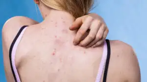 Coșuri de pe spate, o problemă frecventă vara. Ce ajută și ce obiceiuri zilnice agravează acneea