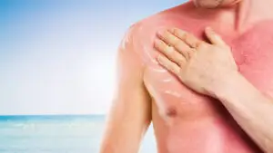 Tratamente naturiste pentru pielea arsă de soare. Remedii simple care calmează rapid usturimea și roșeața