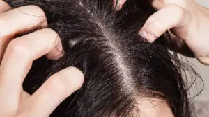 Mătreața, coșmarul românilor! Ce trebuie să faci pentru un scalp sănătos. Obiceiuri de evitat