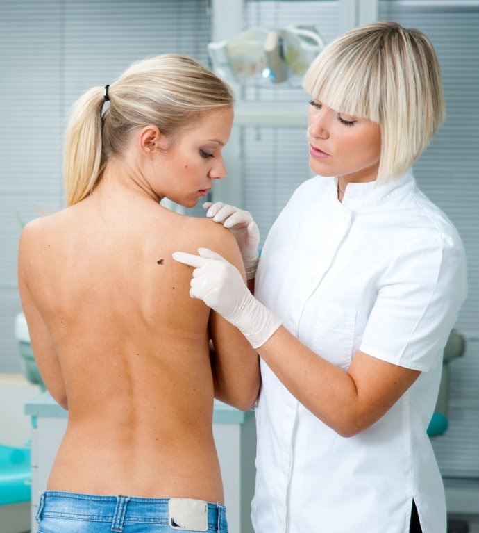 Cum depistezi melanomul o formă de cancer de piele cu o evoluţie foarte agresivă